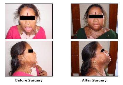 Reconstructive Surgery, Post Burn Deformities Surgery