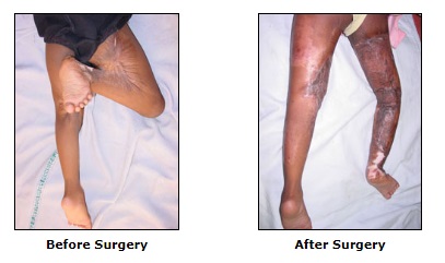 Reconstructive Surgery, Post Burn Deformities Surgery