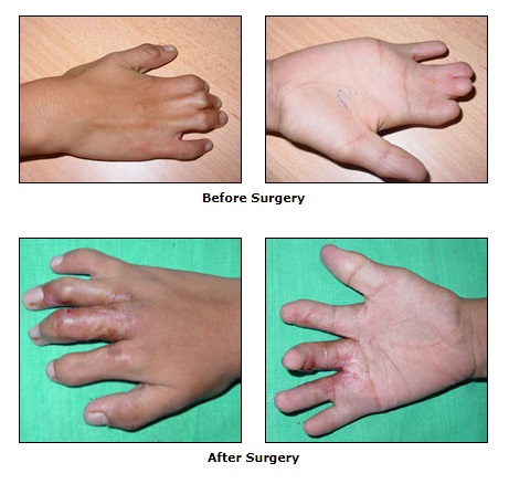 Reconstructive Surgery, Congential Deformities Surgery