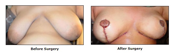 cosmetic Surgery, Breast Reduction Surgery