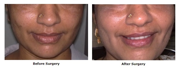 Cosmetic Surgery, Dimple Creation Surgery